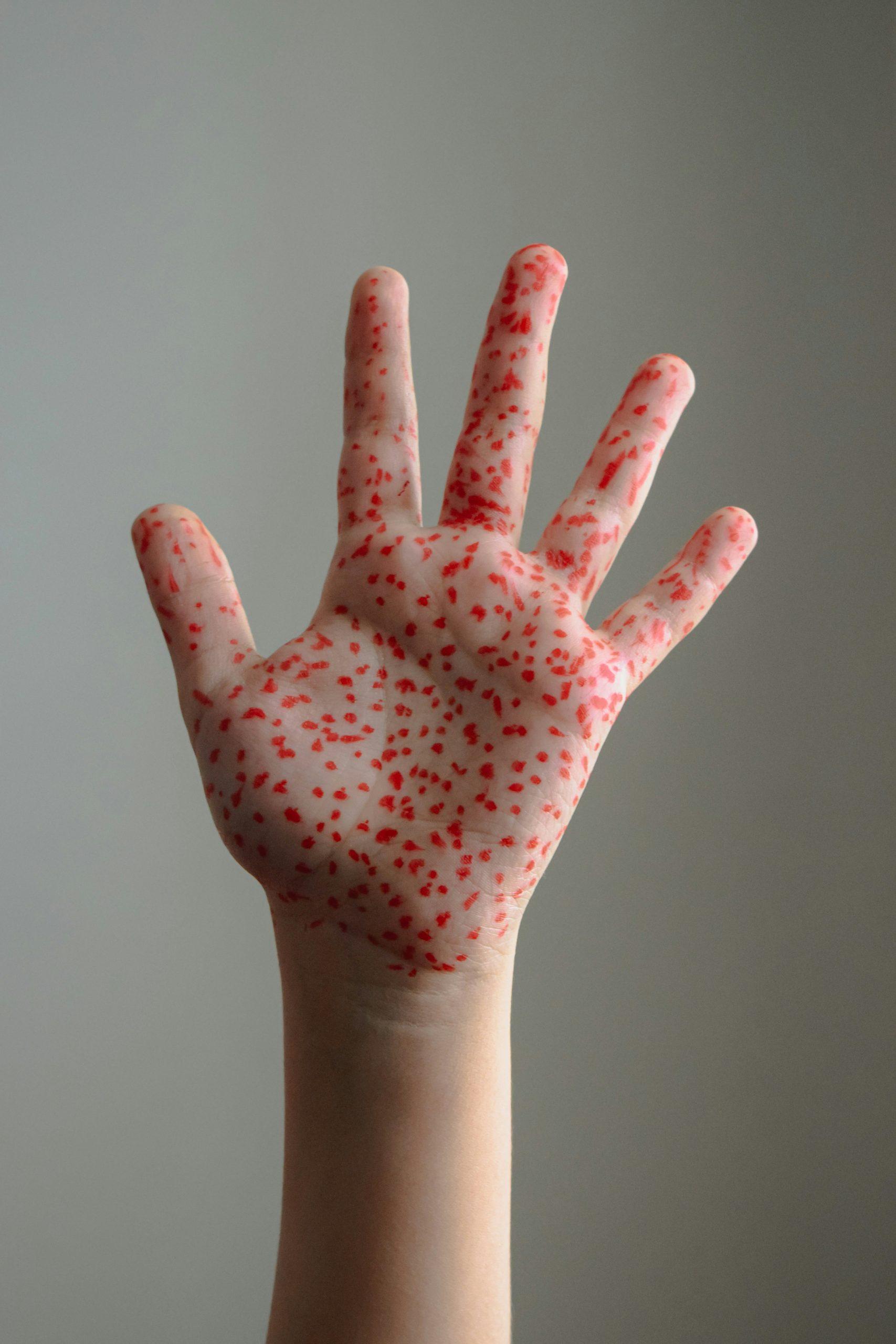 Michigan confirms measles outbreak in Washtenaw County: What to know